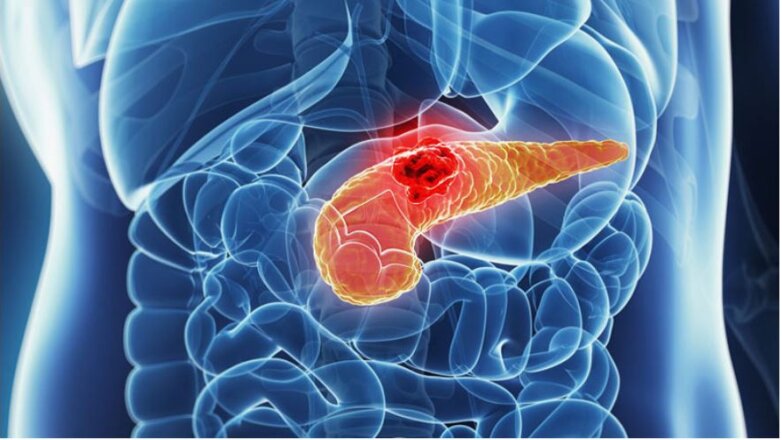 «Ανακαλύφθηκε Επαναστατική Θεραπεία για τον Καρκίνο του Παγκρέατος – Μην Χάσετε Αυτή τη Ζωής-Σώζουσα Εξελίξη!»