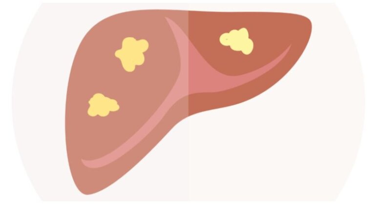 Απίστευτο! Δωρεάν μη επεμβατικός έλεγχος ήπατος στον Πειραιά – Μην τον χάσετε!