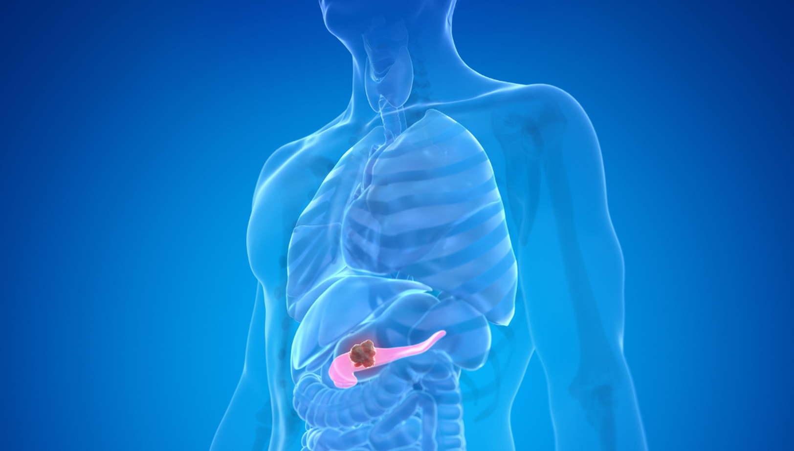 «Ανατρεπτική Έρευνα Αποκαλύπτει Γονίδια που Ίσως Προκαλούν τον Καρκίνο του Παγκρέατος – Μάθε τι έδειξε!»