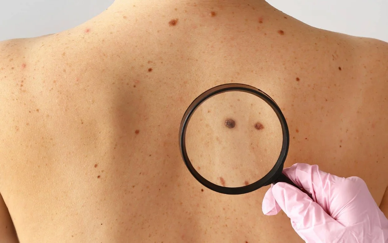 Απίστευτο: Ο ήλιος μπορεί να αποδυναμώσει την άμυνα σου κατά του καρκίνου του δέρματος!