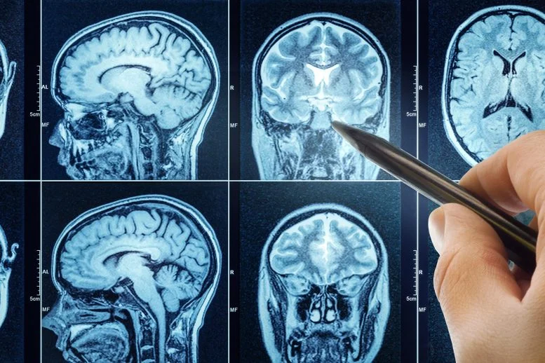 Νέο εγκεφαλικό σήμα προβλέπει τα χρόνια του Αλτσχάιμερ πριν από τη διάγνωση