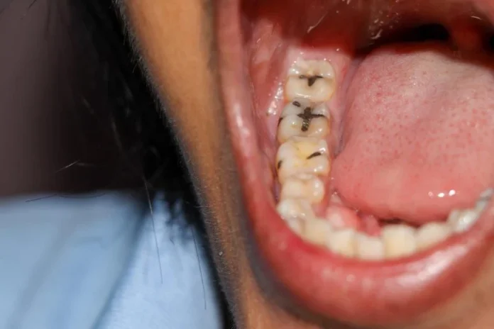 Τεχνητό σάλιο από ζαχαροκάλαμο δείχνει υπόσχεση κατά των σοβαρών κοιλοτήτων