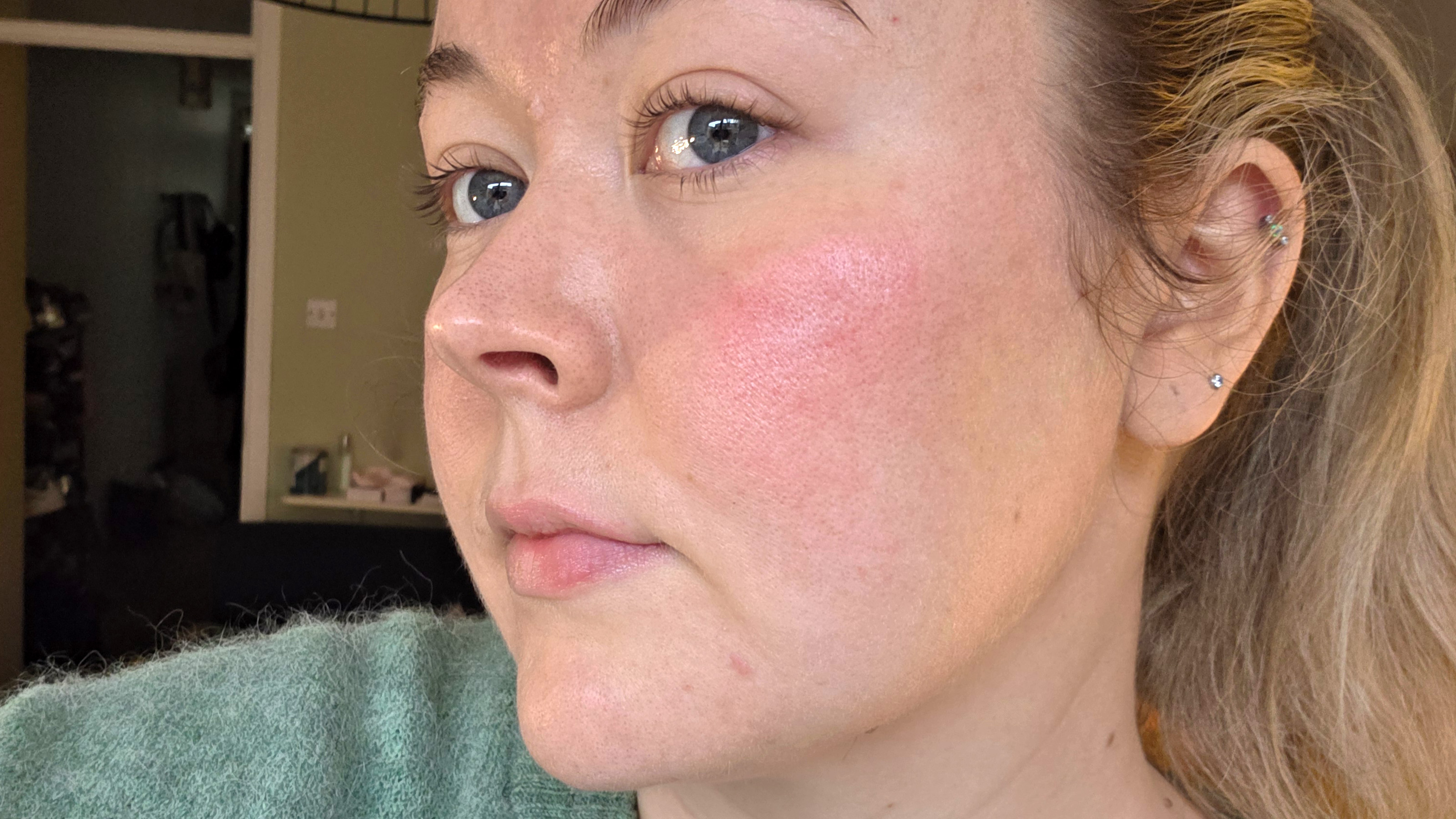 στενό δέρμα μετά τη χρήση της μάσκας Shark CryoGlow