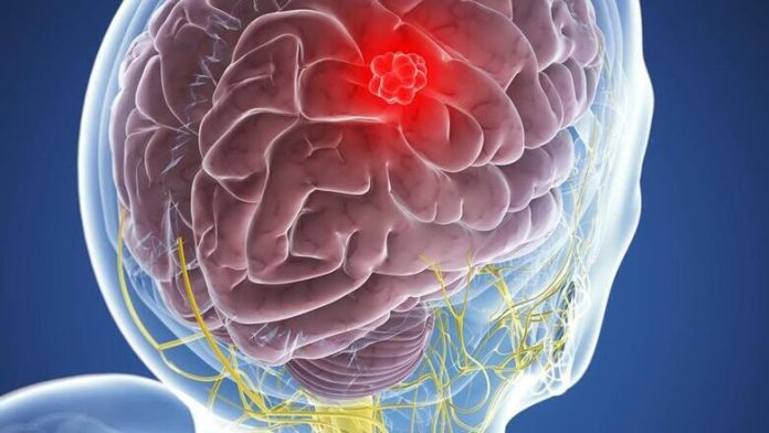 Το «ταξίδι» μιας ασθενούς με μηνιγγίωμα