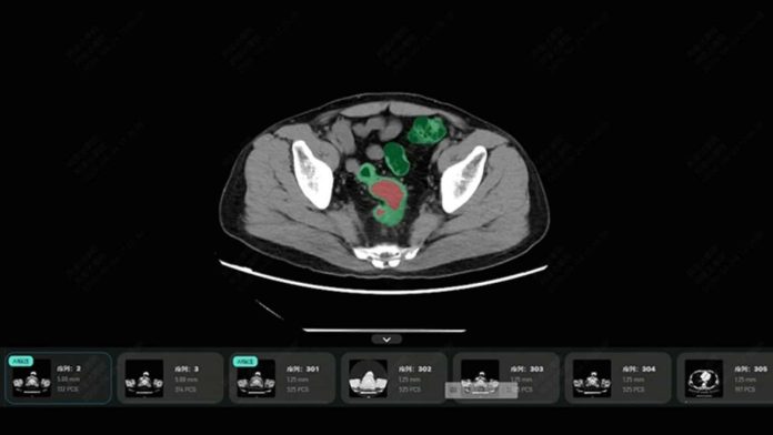 Τέλος στην κολονοσκόπηση; AI κάνει τη διάγνωση μέσω εξέτασης ρουτίνας