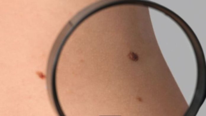 Μελάνωμα: Συμβουλές για προστασία την άνοιξη