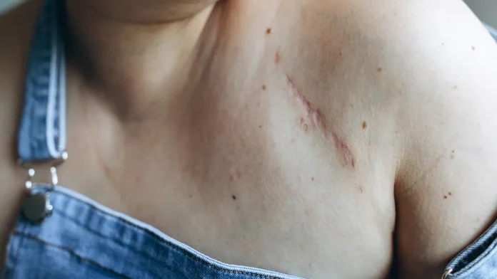 Γιατί τα σημάδια δεν εξαφανίζονται ποτέ | Λαϊκή Επιστήμη